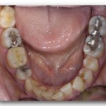 fillings-before