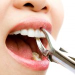 tooth-extraction-san-diego