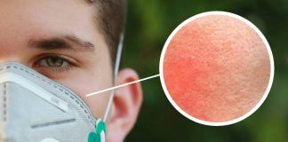 Awas Gatal-gatal Di Sekitar Pipi, Ini Antara 5 Jenis Masalah Kulit Kerana Lama Pakai Topeng Muka!