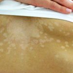 1200px-Tinea_versicolor1