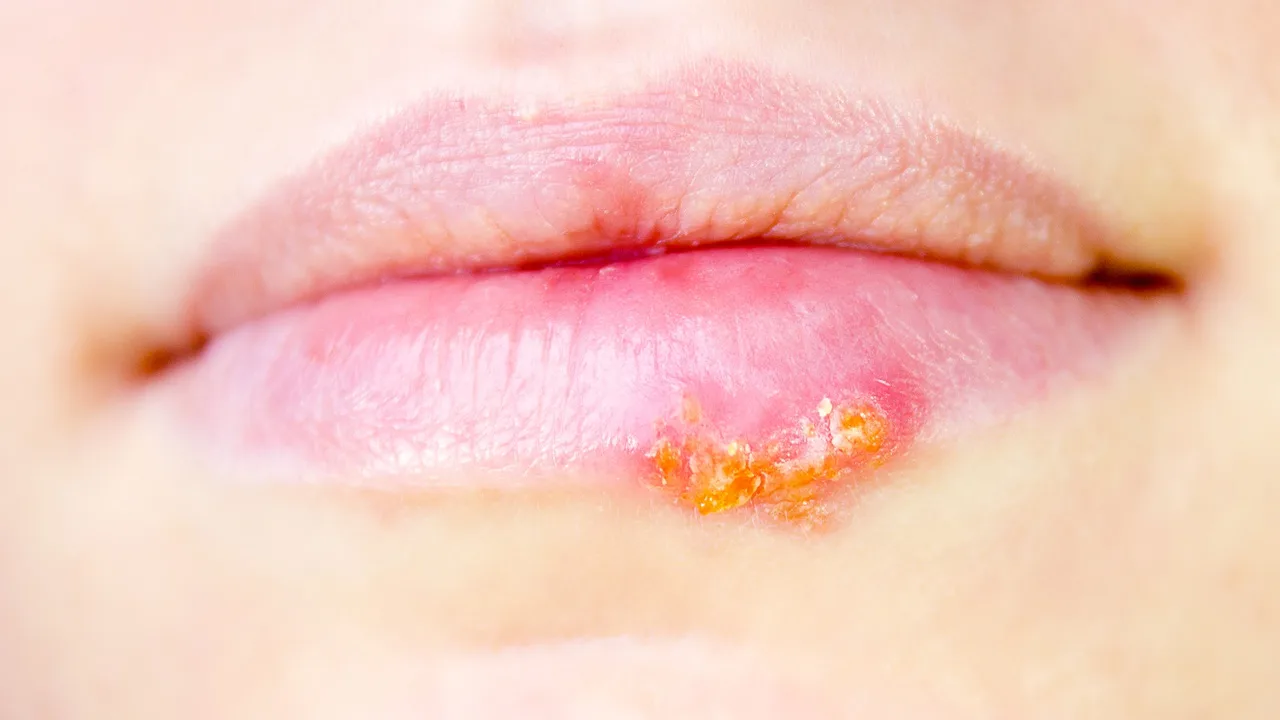‘Telur Suami Masam’ Boleh Jadi Penyebab Herpes? Ini Penjelasan Doktor Ahmad Samhan