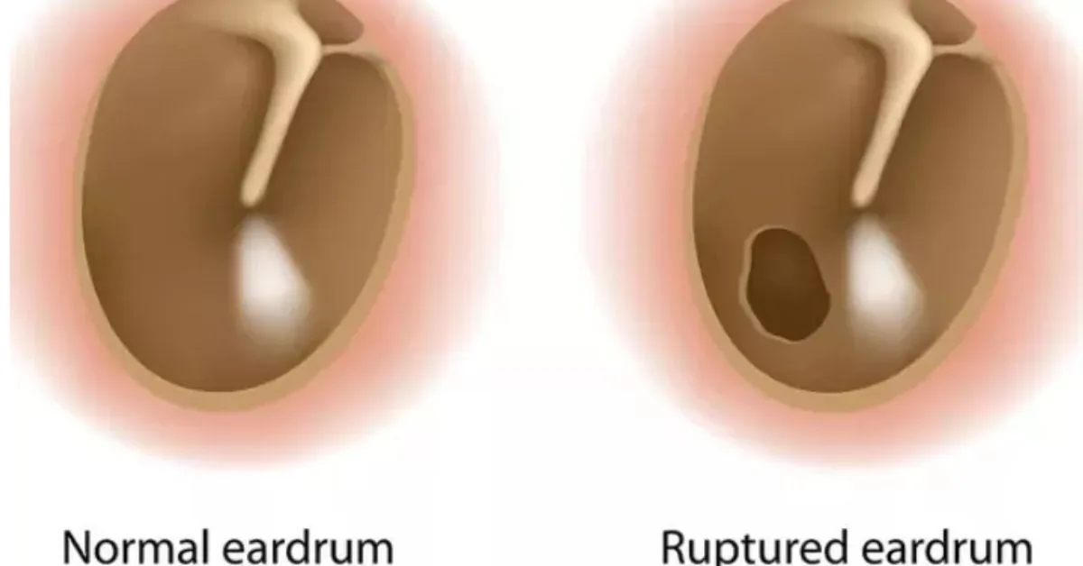 “Hati-Hati Boleh Jadi Pekak” – Doktor Kongsi Cara Betul Bersihkan Telinga Guna Cotton Bud