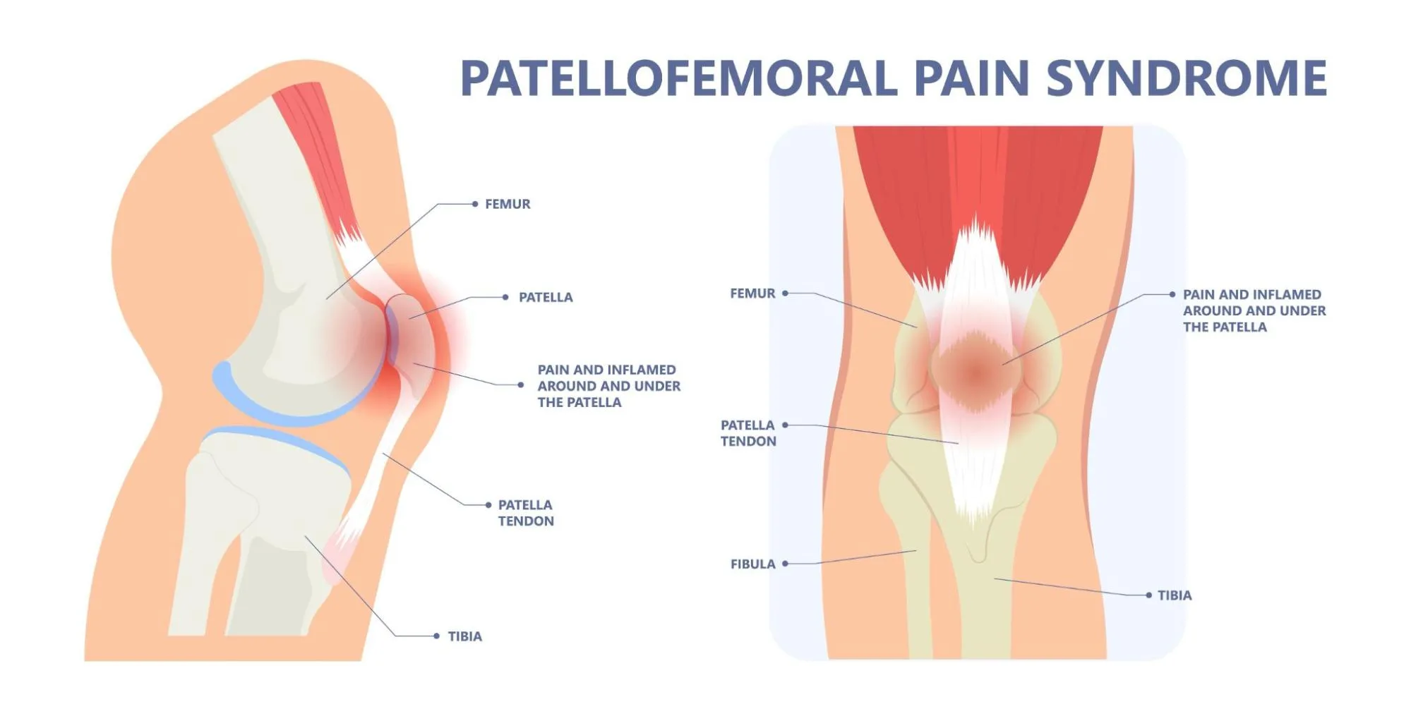 Runner’s Knee, Punca, Simptom & Cara Elak Cedera Klasik Dalam Larian
