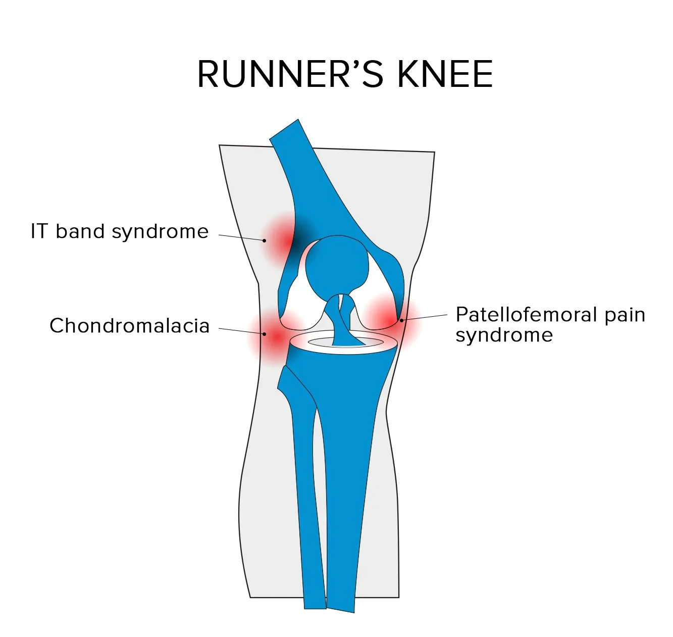Runner’s Knee, Punca, Simptom & Cara Elak Cedera Klasik Dalam Larian