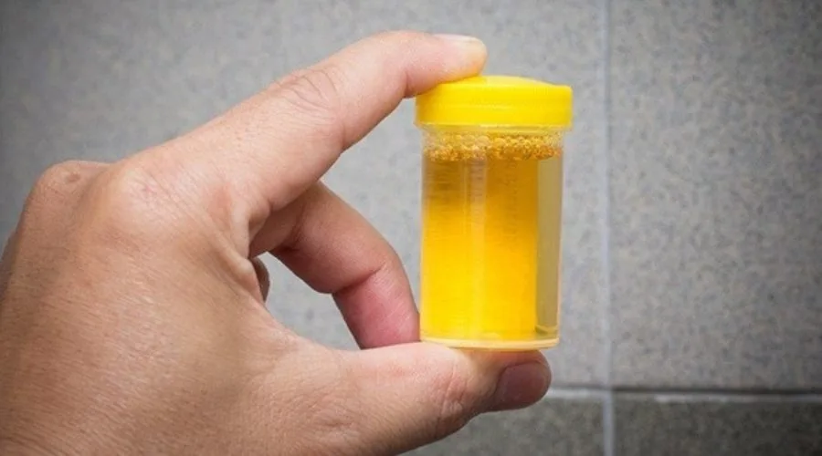 Perhati Warna Dan Bau Air Kencing, Tanda Awal Penyakit Berbahaya